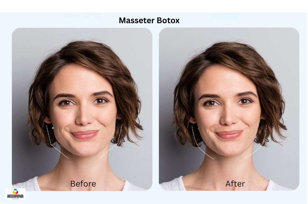 Masseter Botox Before and After